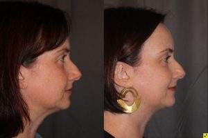 45 year old female three months following Profound RF microneedling to the cheeks and upper neck/chin.