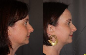 45 year old female three months following Profound RF microneedling to the cheeks and upper neck/chin.