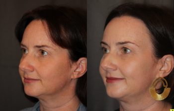 45 year old female three months following Profound RF microneedling to the cheeks and upper neck/chin.