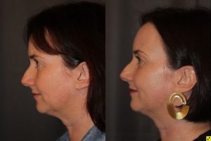 45 year old female three months following Profound RF microneedling to the cheeks and upper neck/chin.