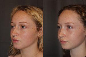 Revision Rhinoplasty - This patient had a revision rhinoplasty where Dr. Stong revised a previous rhinoplasty from another surgeon.