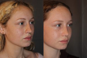 Revision Rhinoplasty - This patient had a revision rhinoplasty where Dr. Stong revised a previous rhinoplasty from another surgeon.