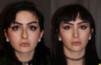 23 year old female 1 month following cosmetic rhinoplasty