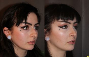 23 year old female 1 month following cosmetic rhinoplasty