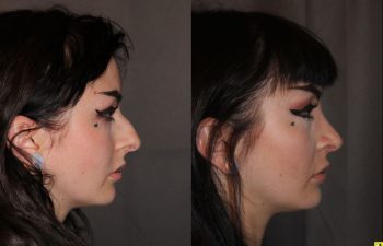 23 year old female 1 month following cosmetic rhinoplasty