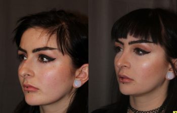 23 year old female 1 month following cosmetic rhinoplasty