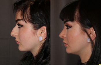 23 year old female 1 month following cosmetic rhinoplasty