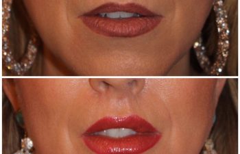 44 year old female 4 months post op from a 6mm modified upper lip lift