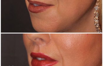 44 year old female 4 months post op from a 6mm modified upper lip lift