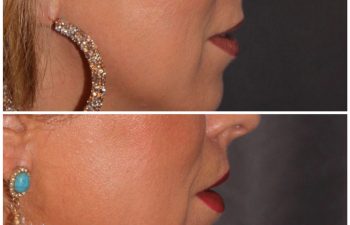 44 year old female 4 months post op from a 6mm modified upper lip lift