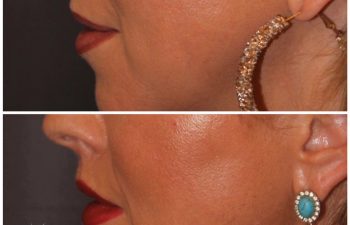 44 year old female 4 months post op from a 6mm modified upper lip lift