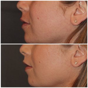 35 year old female 3 months following an upper modified lip lift.