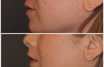 35 year old female 3 months following an upper modified lip lift.