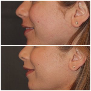 35 year old female 3 months following an upper modified lip lift.