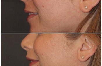 35 year old female 3 months following an upper modified lip lift.