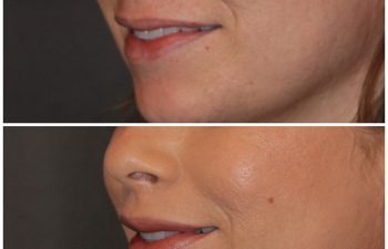 35 year old female 3 months following an upper modified lip lift.