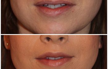 35 year old female 3 months following an upper modified lip lift.