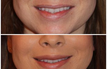 35 year old female 3 months following an upper modified lip lift.