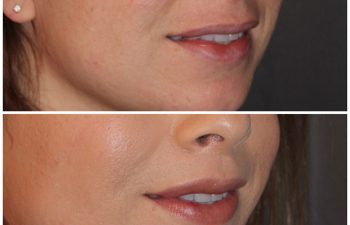 35 year old female 3 months following an upper modified lip lift.
