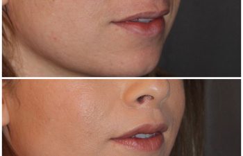 35 year old female 3 months following an upper modified lip lift.