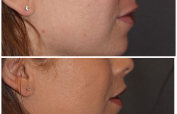 35 year old female 3 months following an upper modified lip lift.