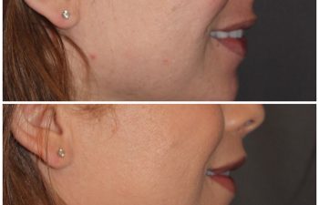 35 year old female 3 months following an upper modified lip lift.