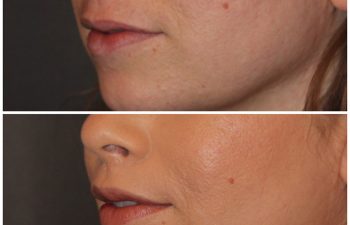 35 year old female 3 months following an upper modified lip lift.