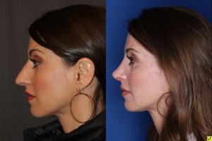 40 Year old Female 3 weeks post op from cosmetic rhinoplasty.