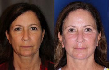 57 year old female 5 months post op from an endoscopic brow lift, upper blepharoplasty, and a Kaloslift deep plane facelift