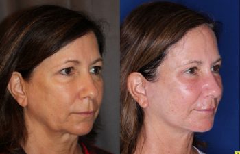 57 year old female 5 months post op from an endoscopic brow lift, upper blepharoplasty, and a Kaloslift deep plane facelift