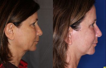 57 year old female 5 months post op from an endoscopic brow lift, upper blepharoplasty, and a Kaloslift deep plane facelift
