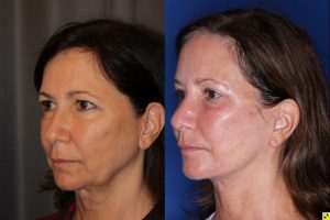 57 year old female 5 months post op from an endoscopic brow lift, upper blepharoplasty, and a Kaloslift deep plane facelift