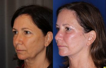 57 year old female 5 months post op from an endoscopic brow lift, upper blepharoplasty, and a Kaloslift deep plane facelift