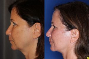 57 year old female 5 months post op from an endoscopic brow lift, upper blepharoplasty, and a Kaloslift deep plane facelift