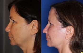 57 year old female 5 months post op from an endoscopic brow lift, upper blepharoplasty, and a Kaloslift deep plane facelift