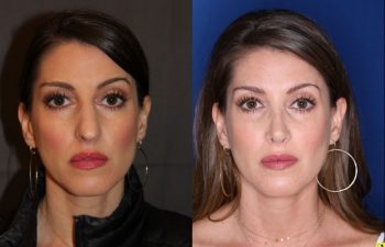40 year old female 4 months post op from rhinoplasty
