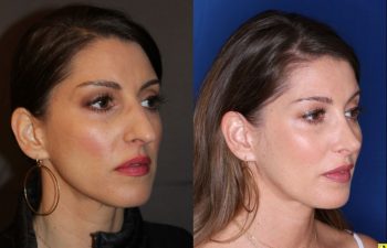 40 year old female 4 months post op from rhinoplasty