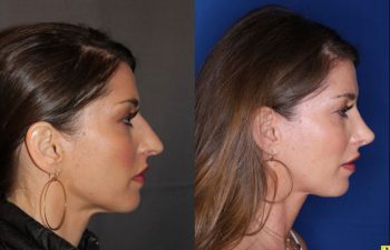 40 year old female 4 months post op from rhinoplasty