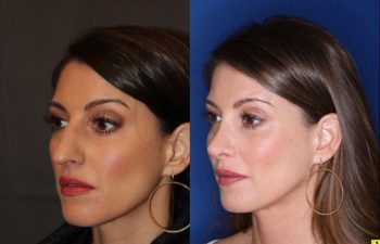 40 year old female 4 months post op from rhinoplasty