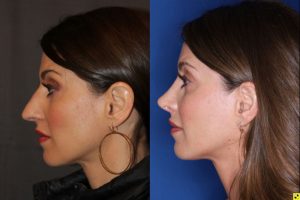40 year old female 4 months post op from rhinoplasty