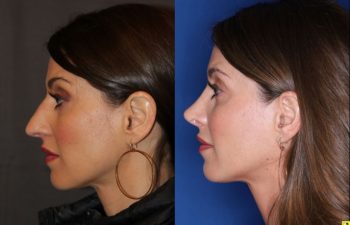 40 year old female 4 months post op from rhinoplasty