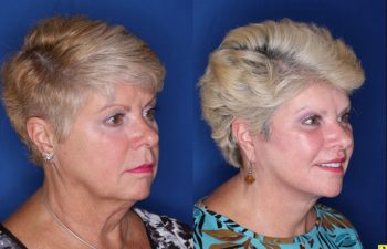 62 year old female 3 months post op from a Kaloslift Deep Plane Facelift and a Modified Lip Lift