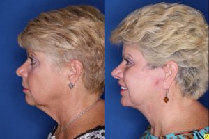 62 year old female 3 months post op from a Kaloslift Deep Plane Facelift and a Modified Lip Lift