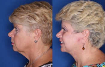 62 year old female 3 months post op from a Kaloslift Deep Plane Facelift and a Modified Lip Lift