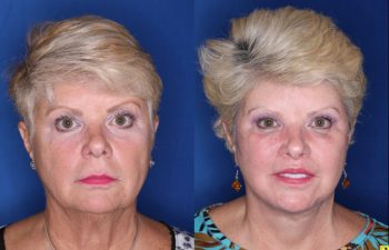 62 year old female 3 months post op from a Kaloslift Deep Plane Facelift and a Modified Lip Lift