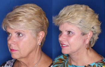 62 year old female 3 months post op from a Kaloslift Deep Plane Facelift and a Modified Lip Lift