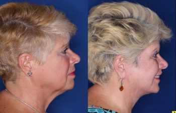 62 year old female 3 months post op from a Kaloslift Deep Plane Facelift and a Modified Lip Lift