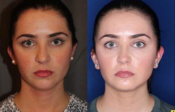 27 year old female four months after two Kybella treatments