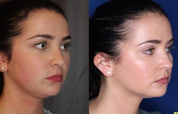 27 year old female four months after two Kybella treatments