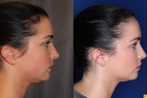 27 year old female four months after two Kybella treatments
